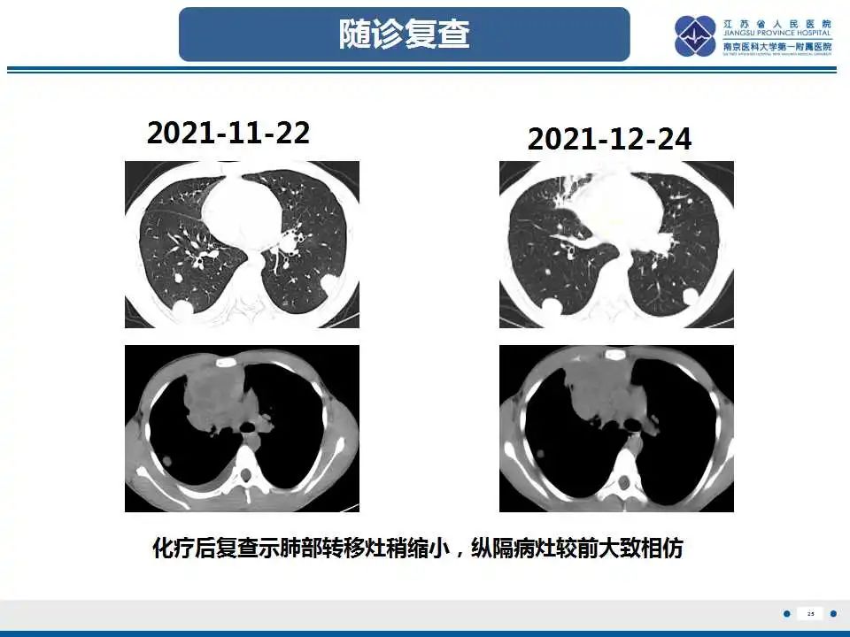 影像PPT - 【PPT】原发性纵隔绒毛膜癌-26