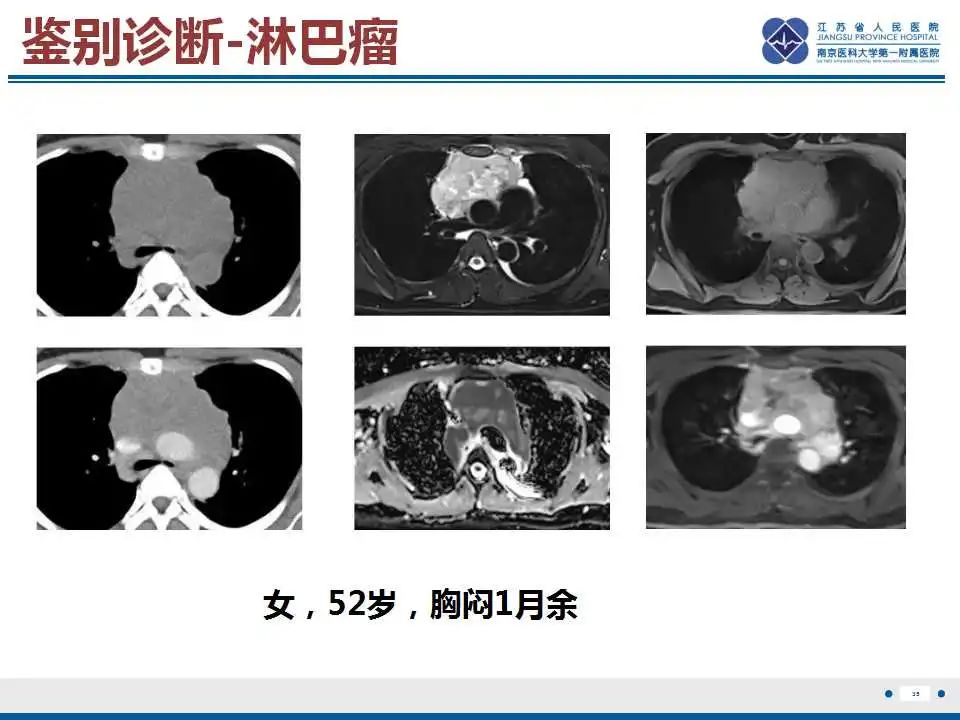 影像PPT - 【PPT】原发性纵隔绒毛膜癌-36