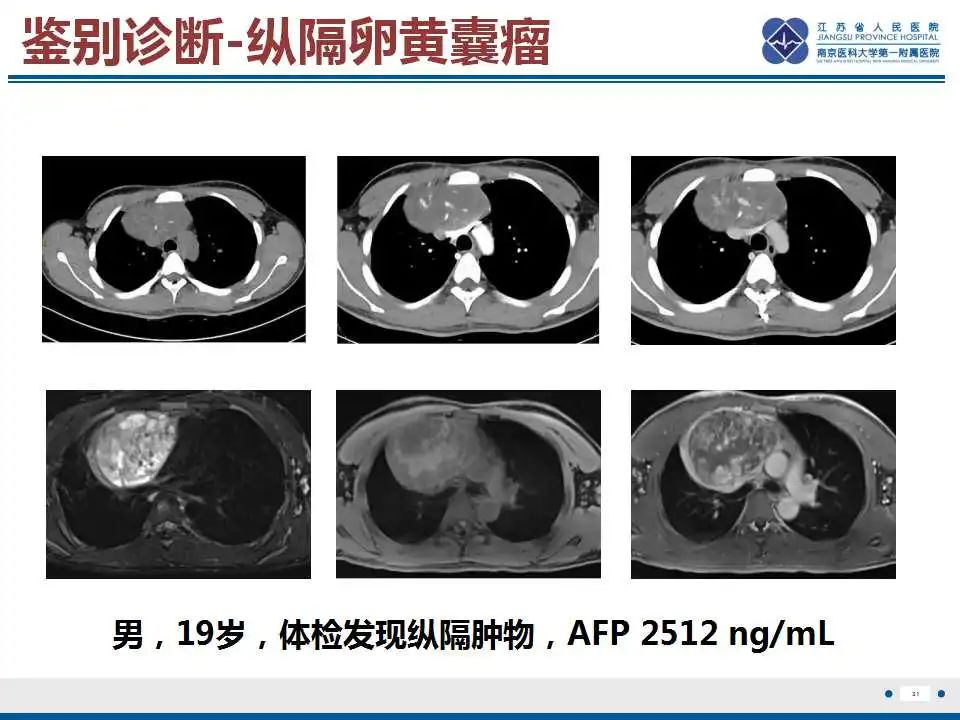 影像PPT - 【PPT】原发性纵隔绒毛膜癌-32