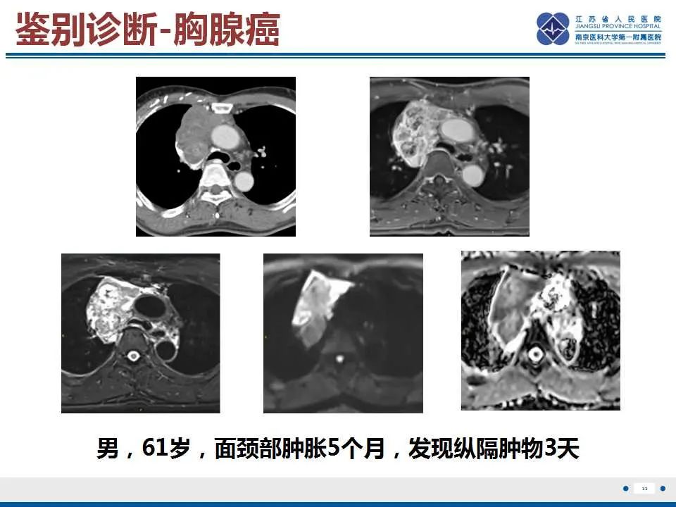 影像PPT - 【PPT】原发性纵隔绒毛膜癌-34