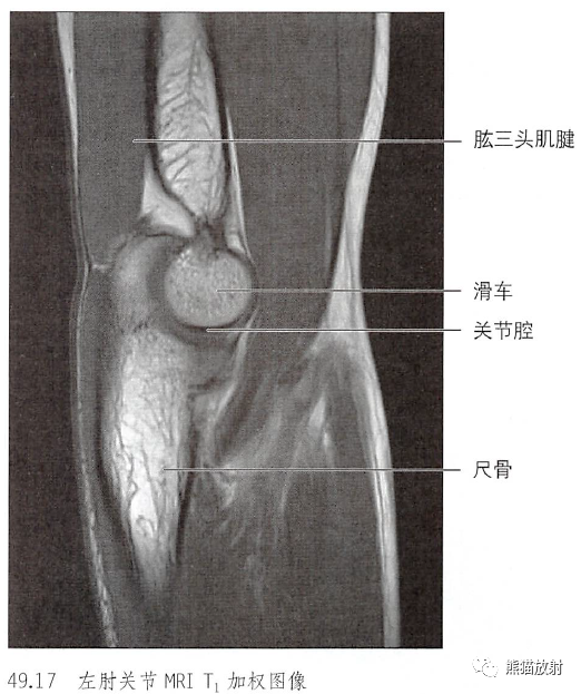 影像PPT - 肩及上肢解剖(上/前臂、手、肘/腕)-38 影像PPT - 肩及上肢解剖(上/前臂、手、肘/腕)-38