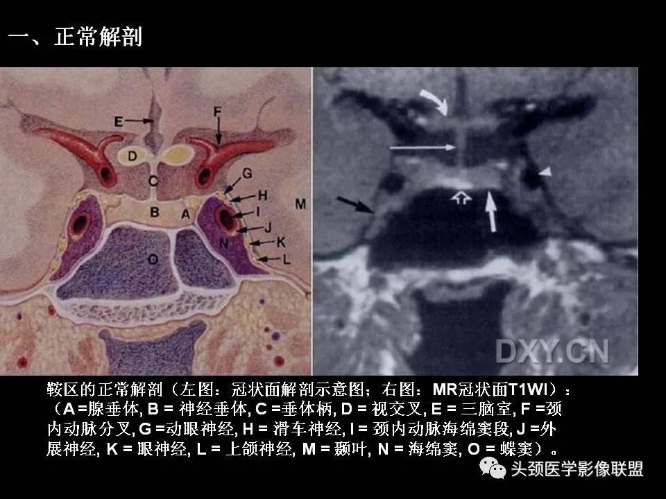 影像PPT - 【PPT】鞍区病变影像诊断-6