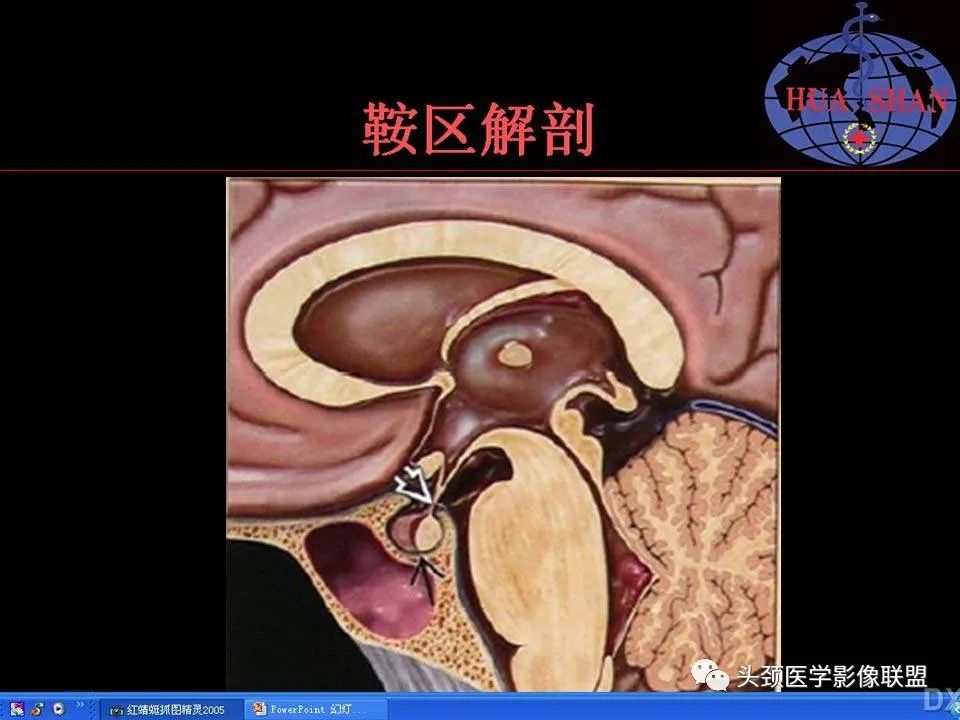 影像PPT - 【PPT】鞍区病变影像诊断-4