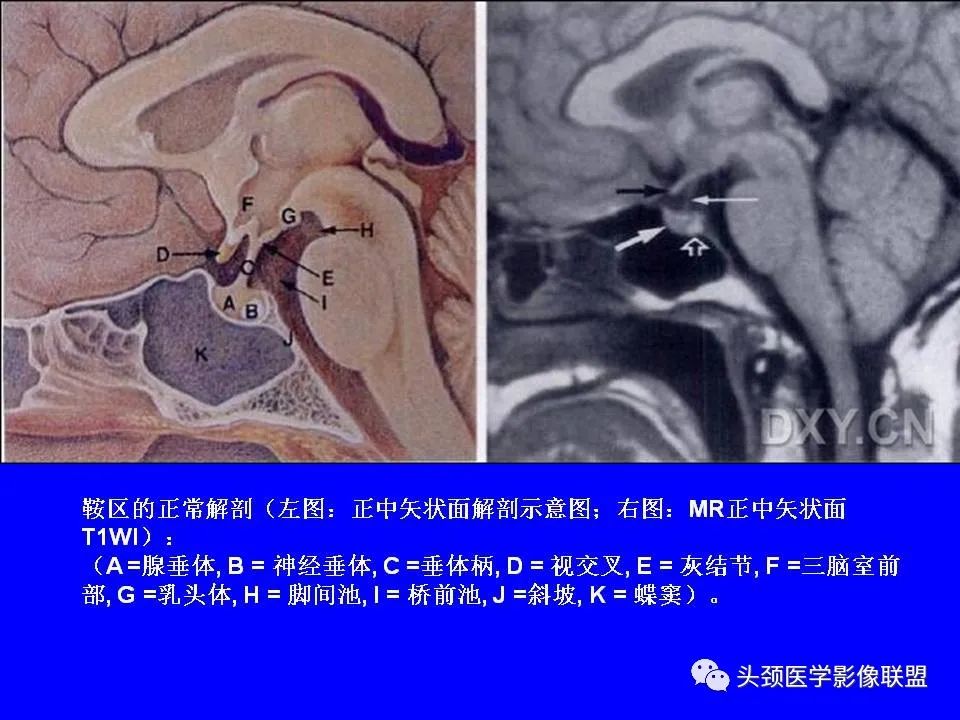 影像PPT - 【PPT】鞍区病变影像诊断-7