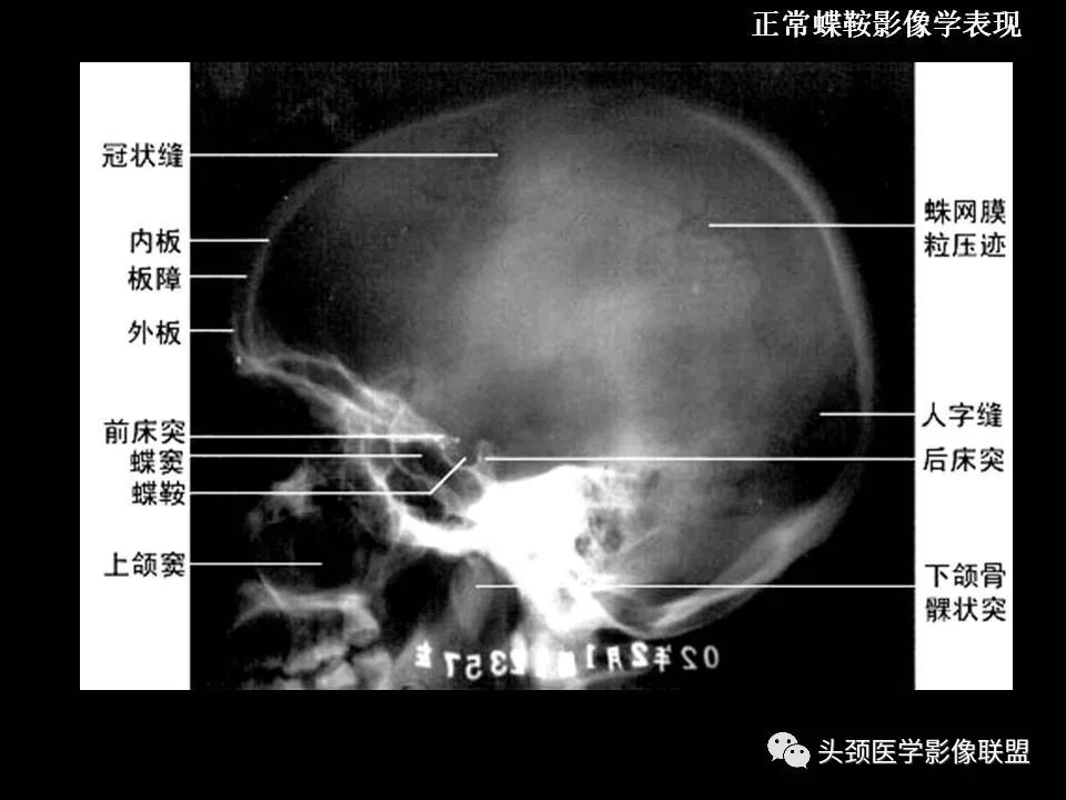 影像PPT - 【PPT】鞍区病变影像诊断-11