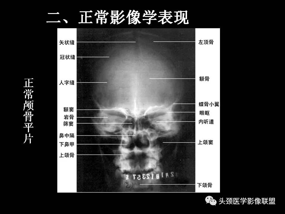 影像PPT - 【PPT】鞍区病变影像诊断-10