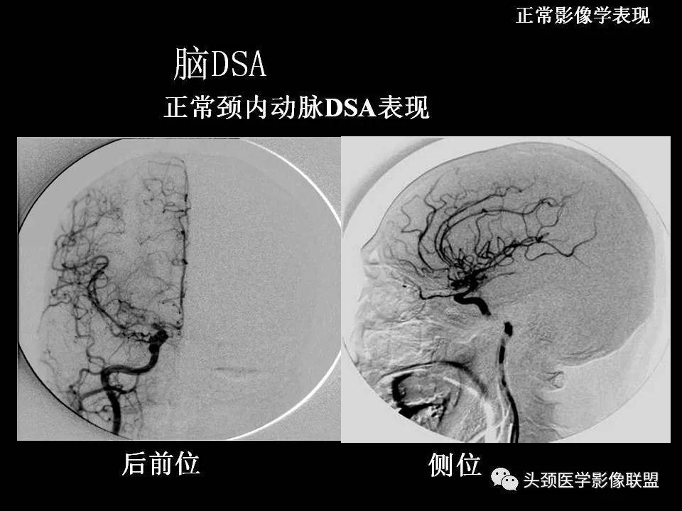 影像PPT - 【PPT】鞍区病变影像诊断-12