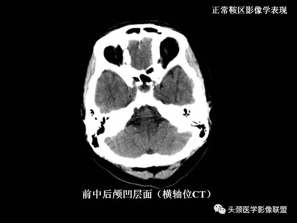 影像PPT - 【PPT】鞍区病变影像诊断-13