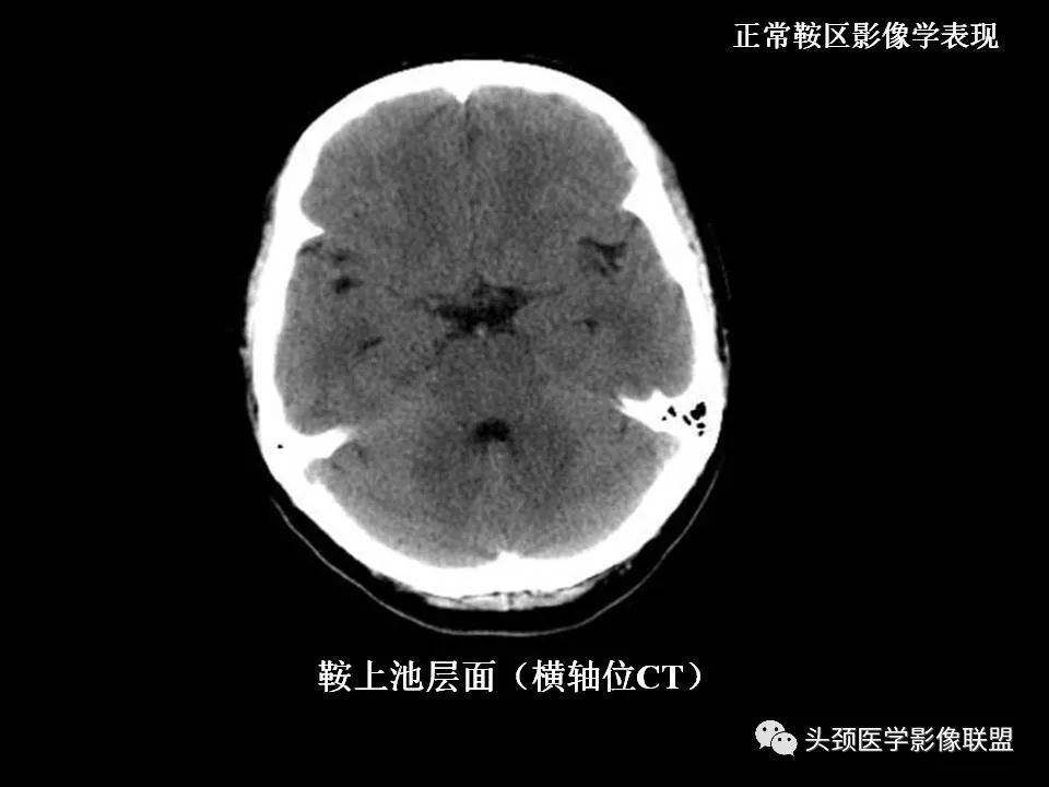 影像PPT - 【PPT】鞍区病变影像诊断-14
