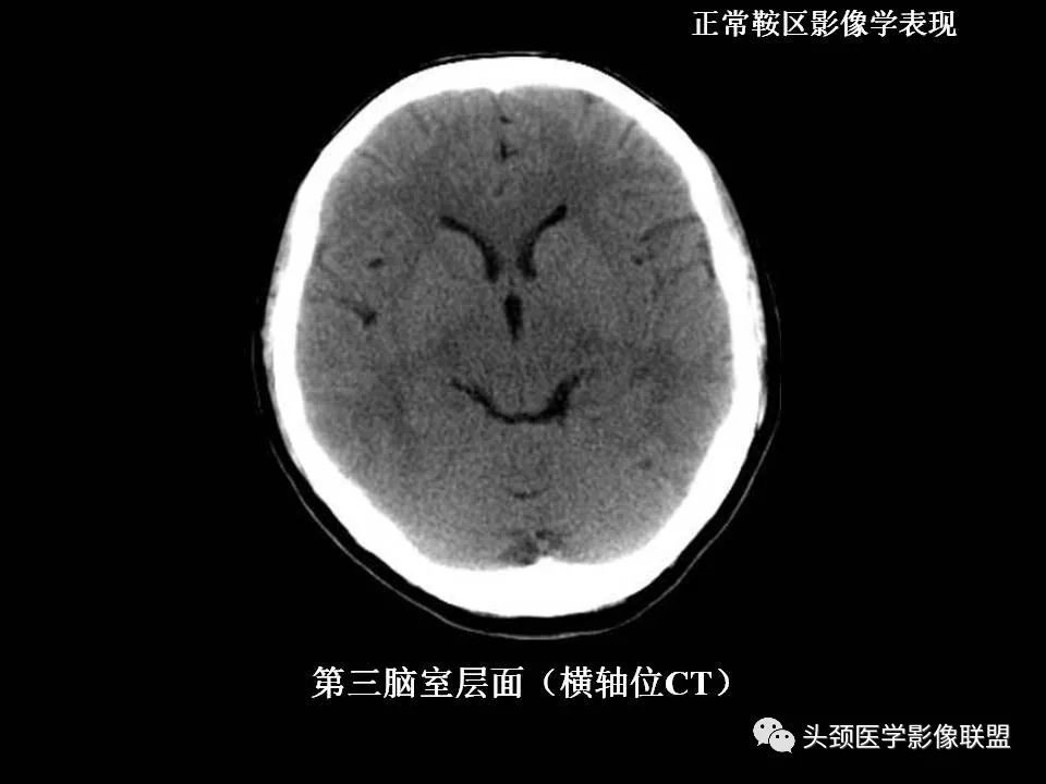 影像PPT - 【PPT】鞍区病变影像诊断-15