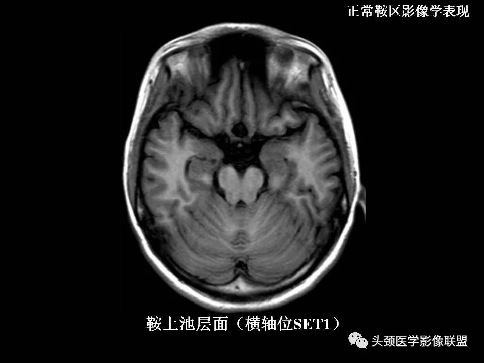 影像PPT - 【PPT】鞍区病变影像诊断-18