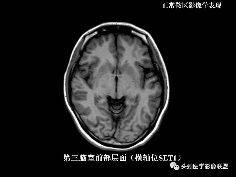 影像PPT - 【PPT】鞍区病变影像诊断-17