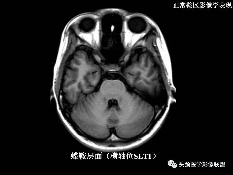 影像PPT - 【PPT】鞍区病变影像诊断-19
