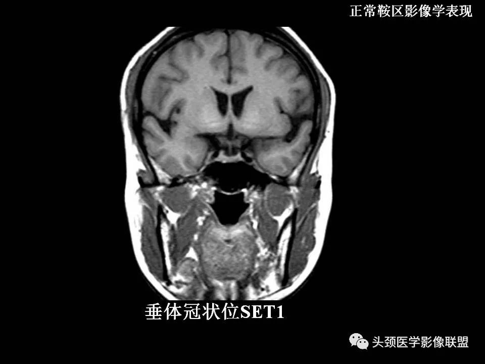 影像PPT - 【PPT】鞍区病变影像诊断-21