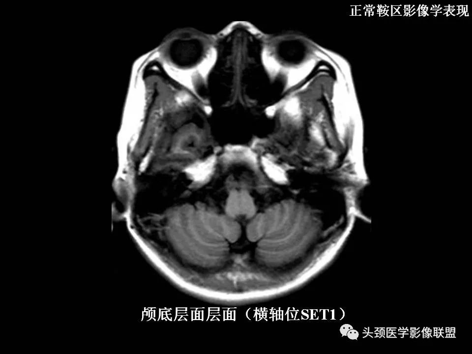 影像PPT - 【PPT】鞍区病变影像诊断-20