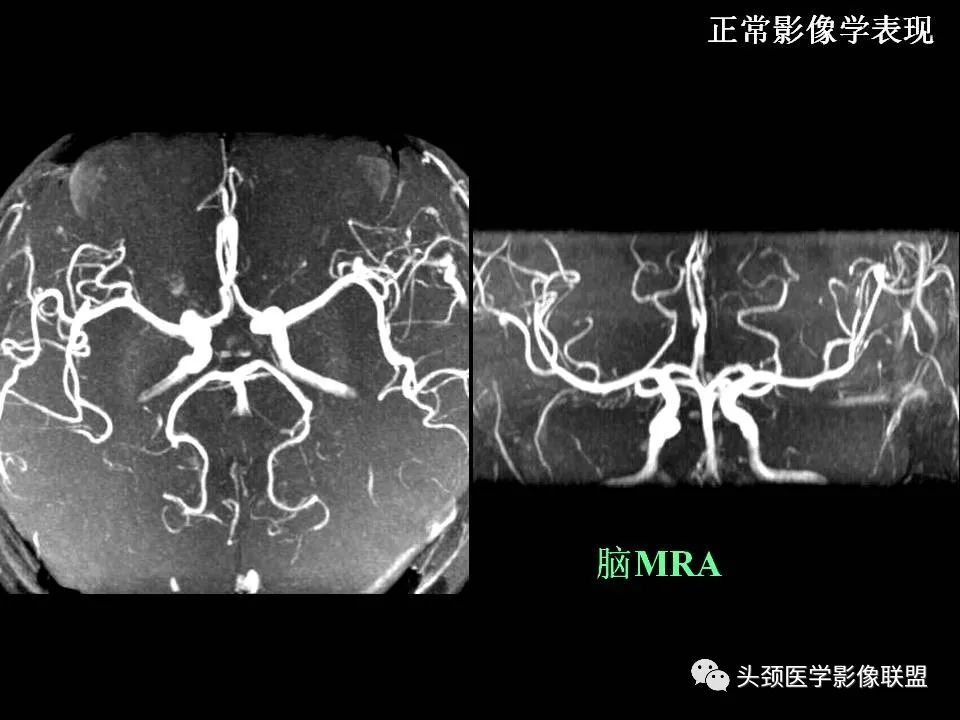 影像PPT - 【PPT】鞍区病变影像诊断-23