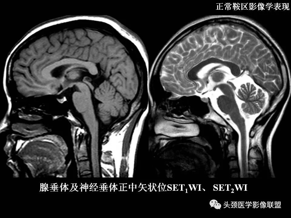 影像PPT - 【PPT】鞍区病变影像诊断-22