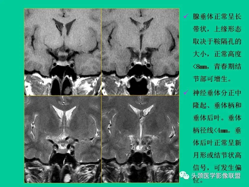 影像PPT - 【PPT】鞍区病变影像诊断-26
