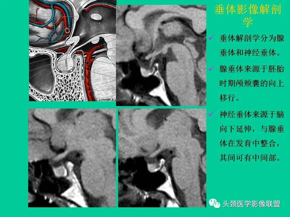 影像PPT - 【PPT】鞍区病变影像诊断-25