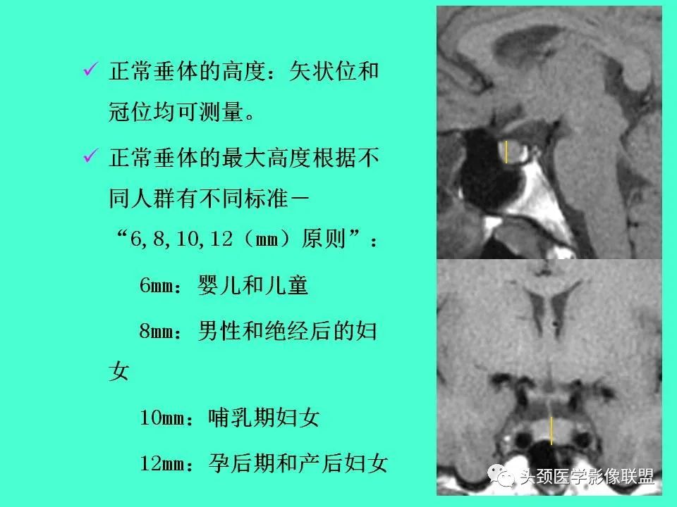 影像PPT - 【PPT】鞍区病变影像诊断-27