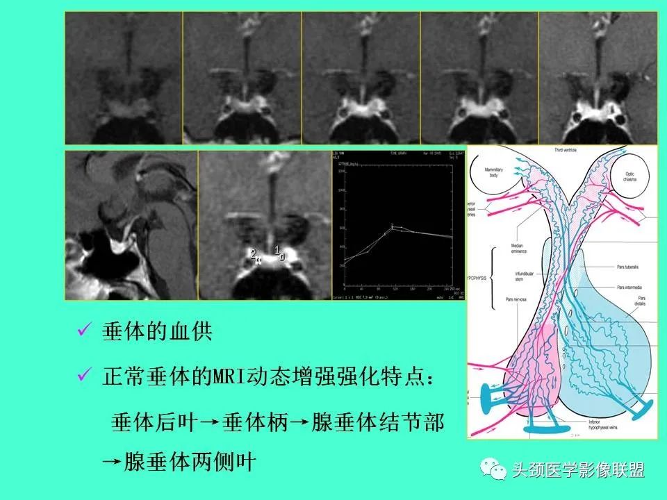 影像PPT - 【PPT】鞍区病变影像诊断-29