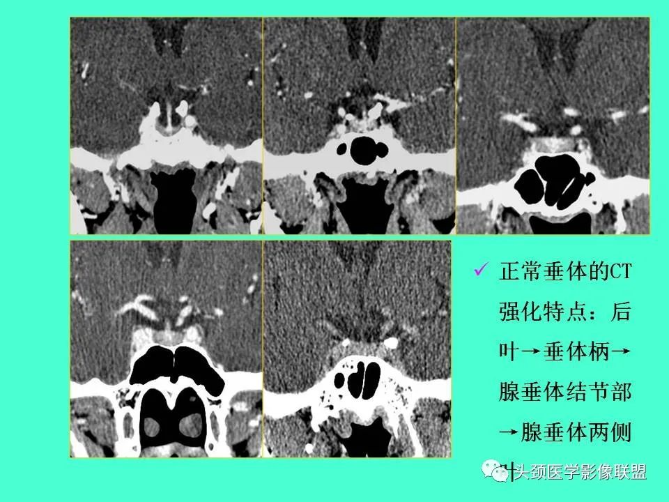 影像PPT - 【PPT】鞍区病变影像诊断-30