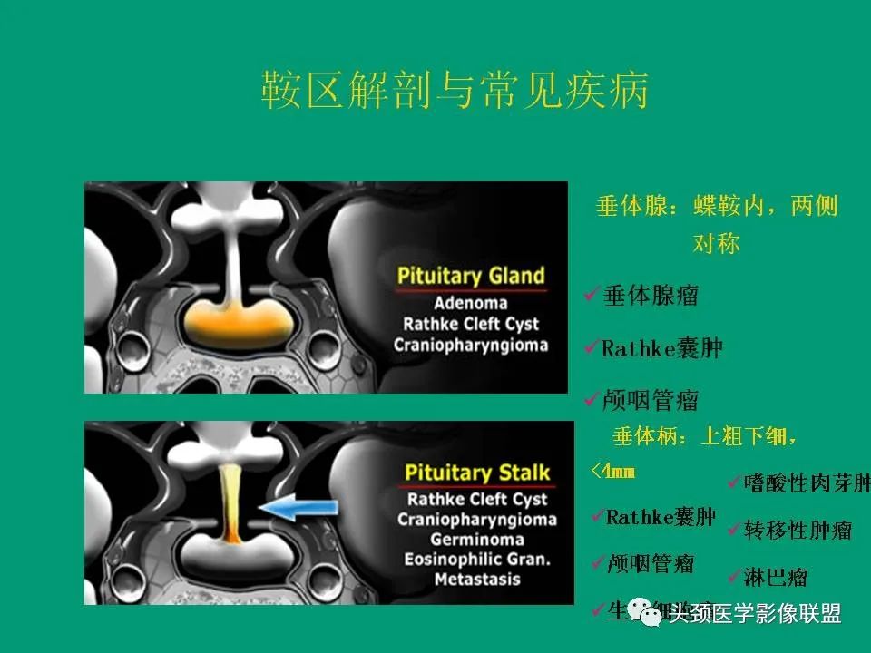 影像PPT - 【PPT】鞍区病变影像诊断-31