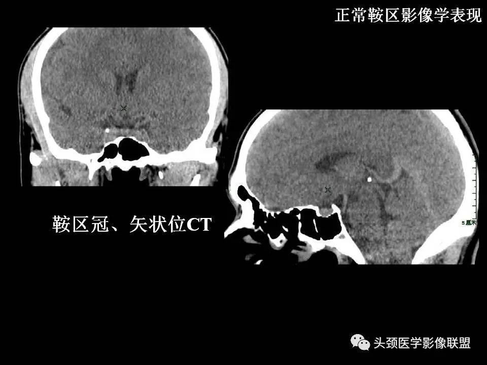 影像PPT - 【PPT】鞍区病变影像诊断-16