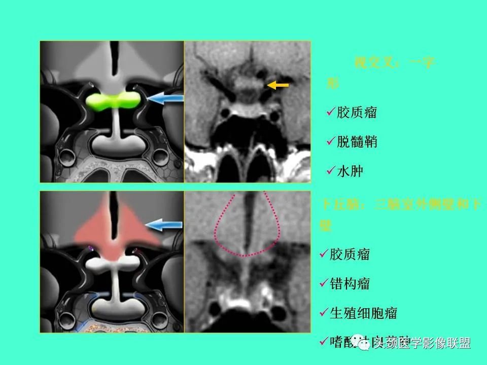 影像PPT - 【PPT】鞍区病变影像诊断-32