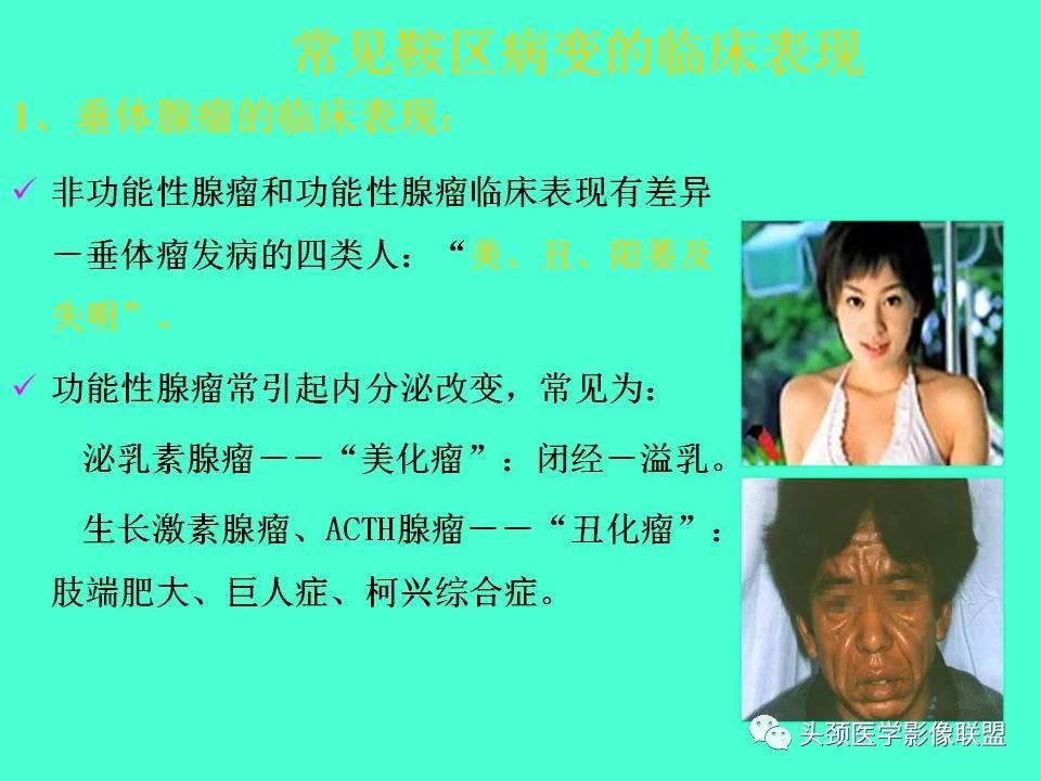 影像PPT - 【PPT】鞍区病变影像诊断-35