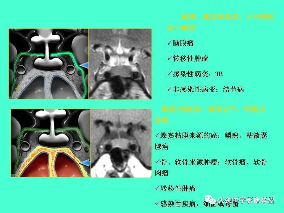 影像PPT - 【PPT】鞍区病变影像诊断-34