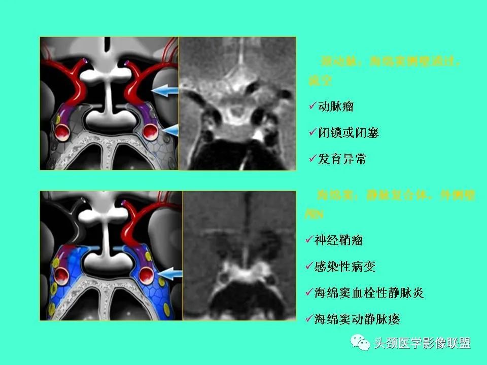 影像PPT - 【PPT】鞍区病变影像诊断-33
