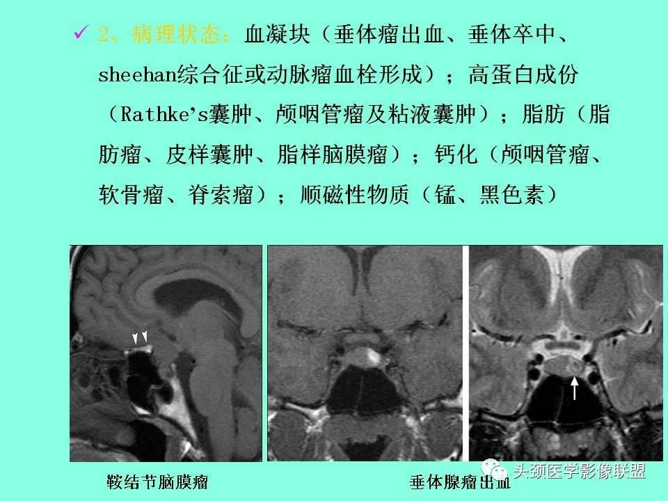 影像PPT - 【PPT】鞍区病变影像诊断-42