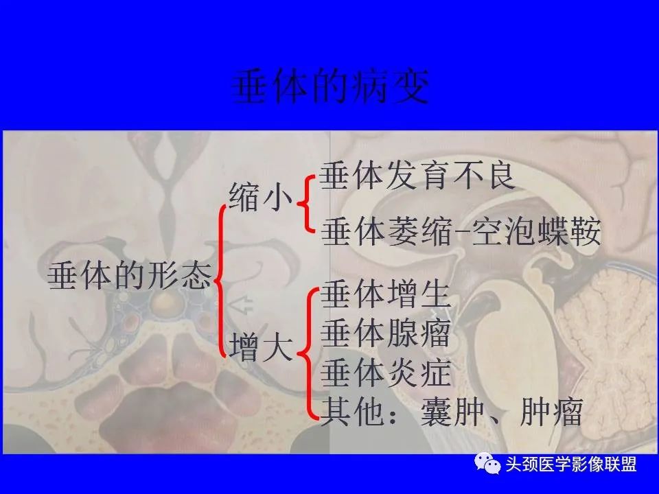 影像PPT - 【PPT】鞍区病变影像诊断-44