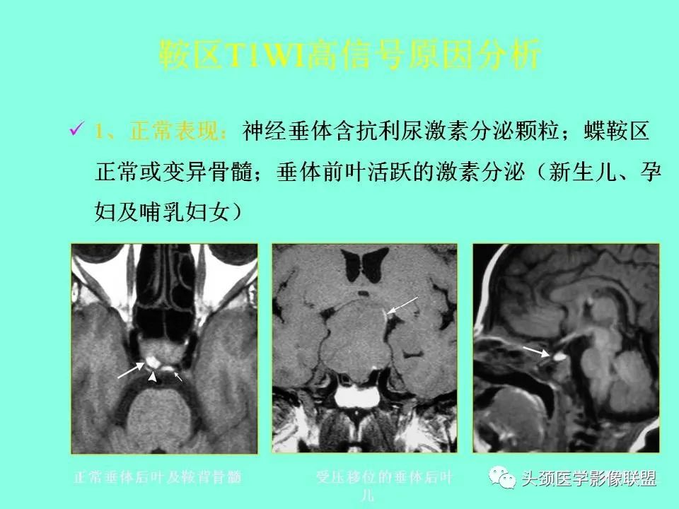 影像PPT - 【PPT】鞍区病变影像诊断-41