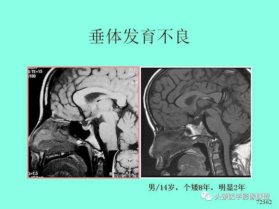 影像PPT - 【PPT】鞍区病变影像诊断-48