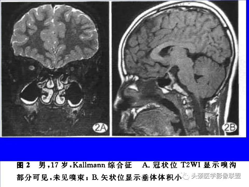 影像PPT - 【PPT】鞍区病变影像诊断-47
