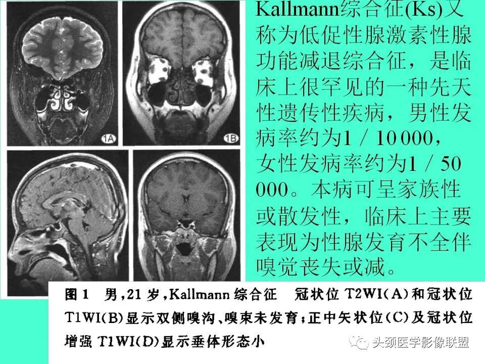 影像PPT - 【PPT】鞍区病变影像诊断-46