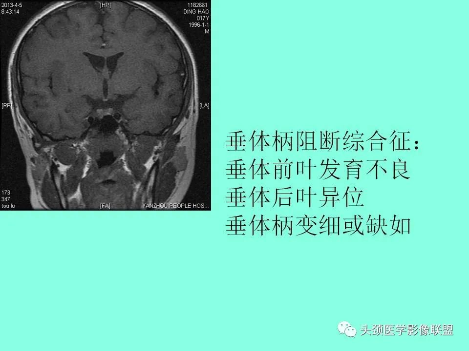 影像PPT - 【PPT】鞍区病变影像诊断-50