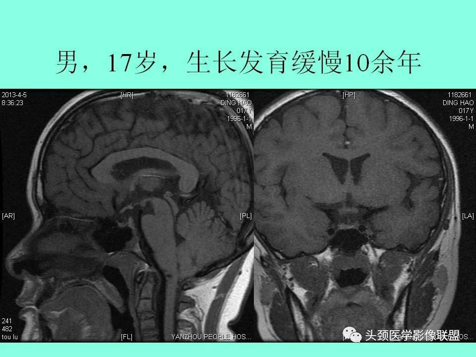 影像PPT - 【PPT】鞍区病变影像诊断-49
