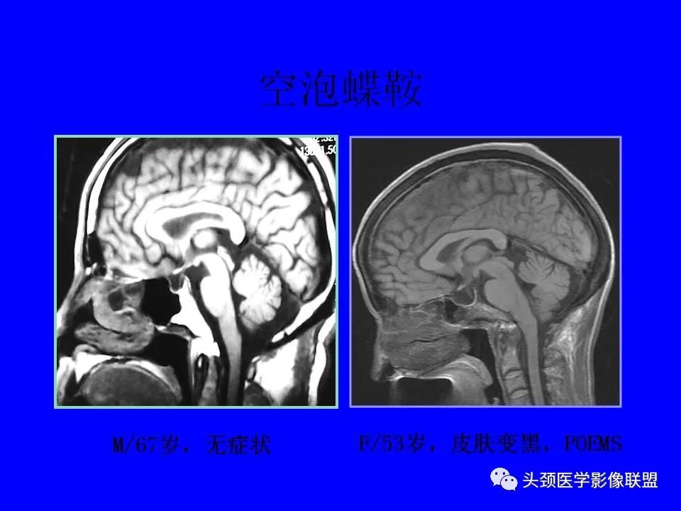 影像PPT - 【PPT】鞍区病变影像诊断-51