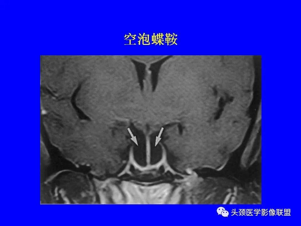 影像PPT - 【PPT】鞍区病变影像诊断-52