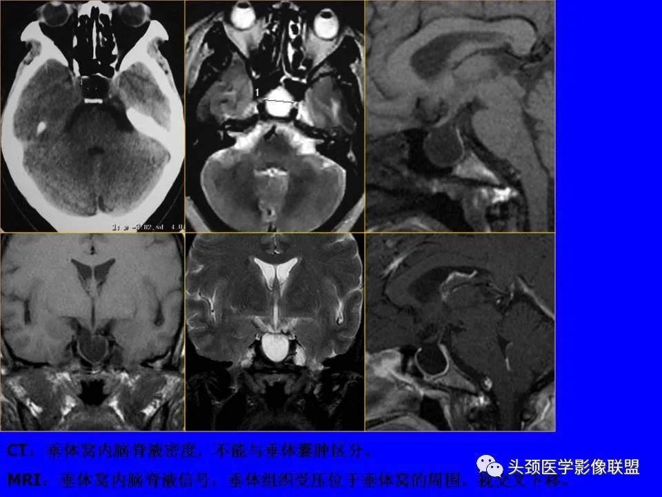 影像PPT - 【PPT】鞍区病变影像诊断-54
