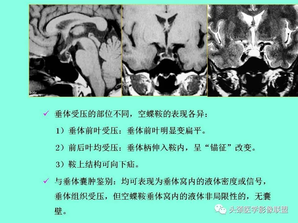 影像PPT - 【PPT】鞍区病变影像诊断-55