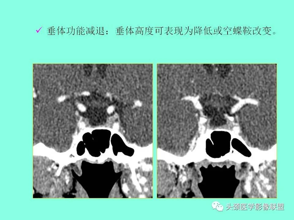 影像PPT - 【PPT】鞍区病变影像诊断-56