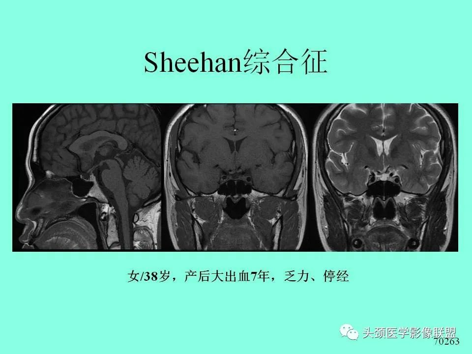 影像PPT - 【PPT】鞍区病变影像诊断-57