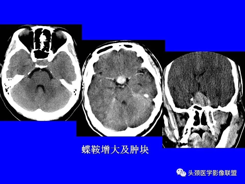 影像PPT - 【PPT】鞍区病变影像诊断-62
