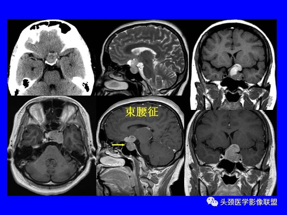 影像PPT - 【PPT】鞍区病变影像诊断-64