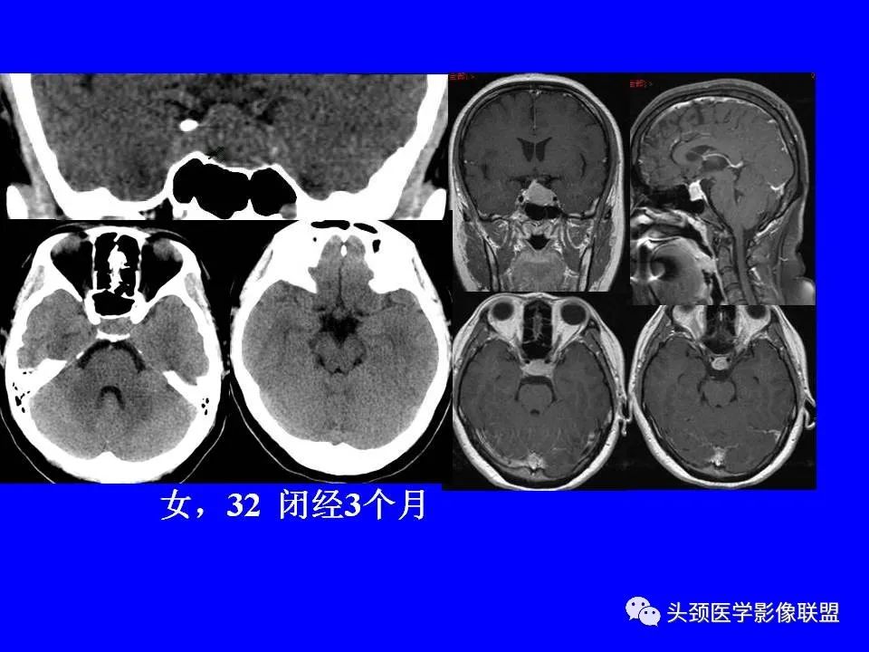 影像PPT - 【PPT】鞍区病变影像诊断-63