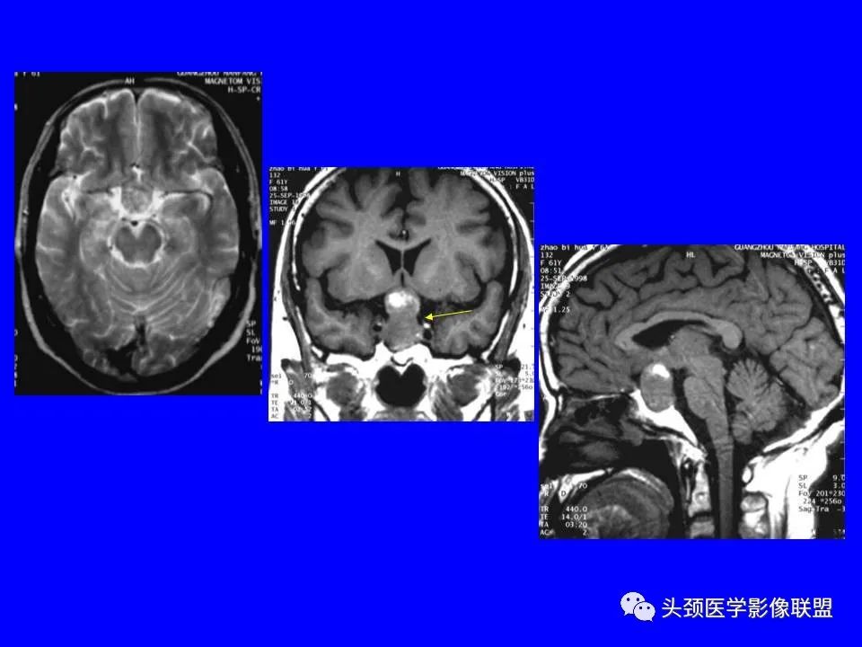 影像PPT - 【PPT】鞍区病变影像诊断-66